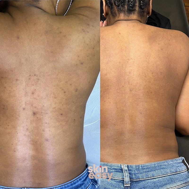 Gant anti-peau morte